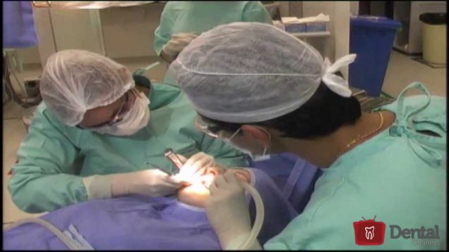 Cirurgia demonstrativa de levantamento de seio maxilar atraumático e instalação de implante