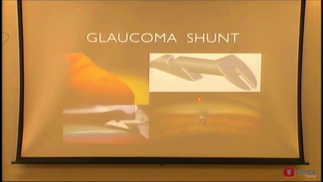 Lentes e Drenos Oftalmológicos