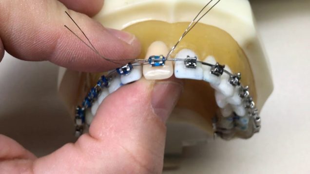 Provisório com Dente de Estoque em Ortodontia – Replacing missing teeth in Orthodontics