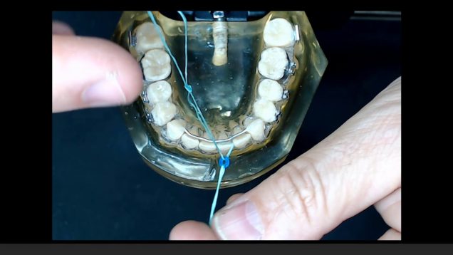 Realinhamento de incisivo inferior – Realigment of inferior incisor crowding relapse