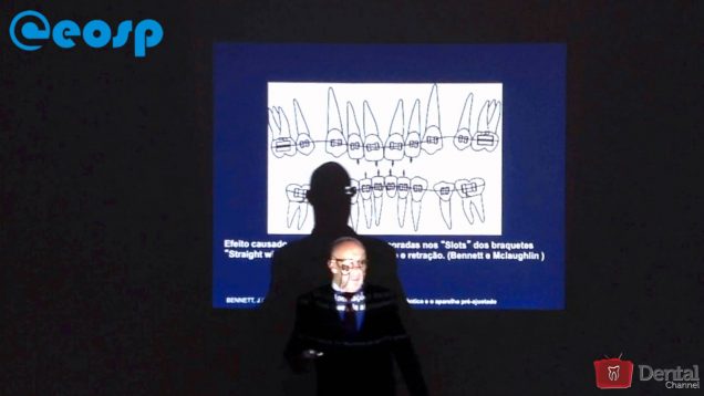 Uso inteligente de acessórios na biomecânica ortodôntica