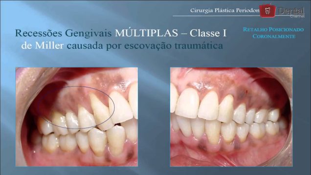 Como Obter Sucesso no Tratamento das Recessões Gengivais com Dra. Tatiana Deliberador